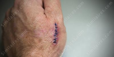 des points de suture films
